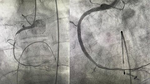 interventional radiology procedure