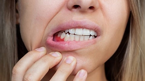 mouth bacteria