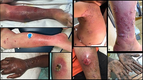 Flood and skin disease