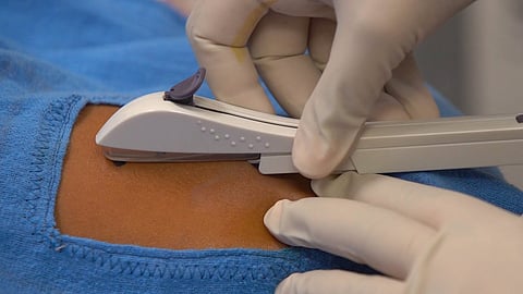 Assam: Subdermal implant for family planning kicks off in Cachar