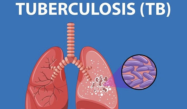 100-Day TB-Free Drive in Kamrup Screens 5,792, Detects 187 New Cases