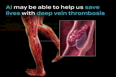 The “Clot” Thickens with Artificial Intelligence