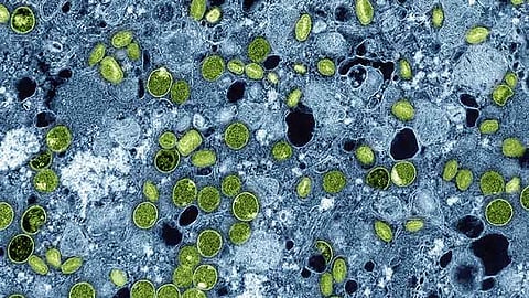 Bacolod records 1st case of mpox