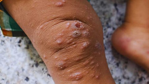Davao City confirms 6 Mpox cases; face masks not mandatory