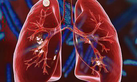 Davao City logs 2-K TB Q1 cases, CHO ramps up detection efforts 