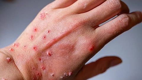 3 Mpox cases in Davao de Oro