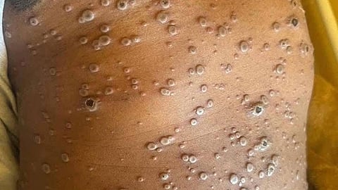 Mpox padayong nitakod