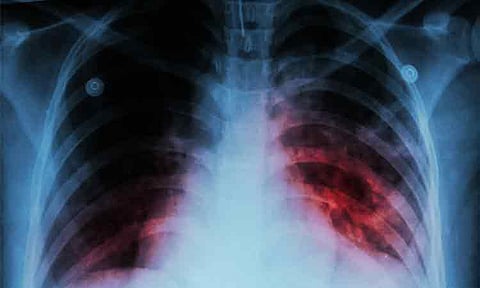 Youth involvement crucial in fight vs TB