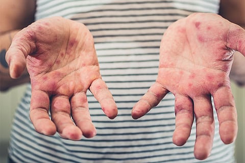 HFMD cases jump by over 600%