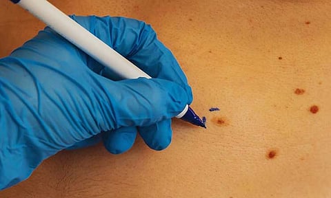 Public urged: Seek doctor’s advice for skin problems