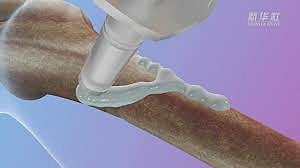 China Bone Glue Repair Bone in Three Minutes News in Tamil