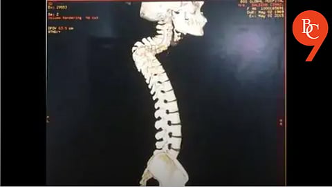 Doctors Save 12-Year-Old from Paralysis with Endoscopic Spine Surgery