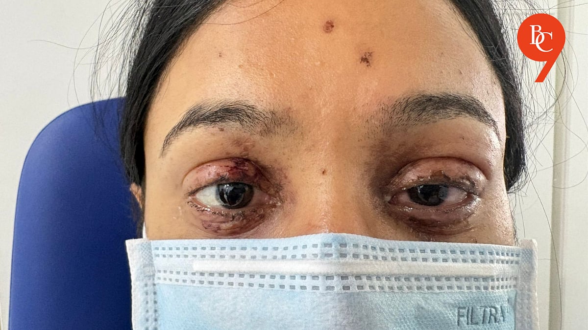 Nepali Student Suffers Eye Injury While Bursting Crackers in Pune ...