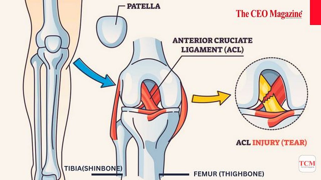 Acl Injuries Rugby Guide to ACL Injuries