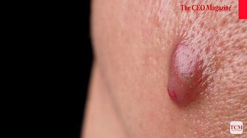 What is Abscess?