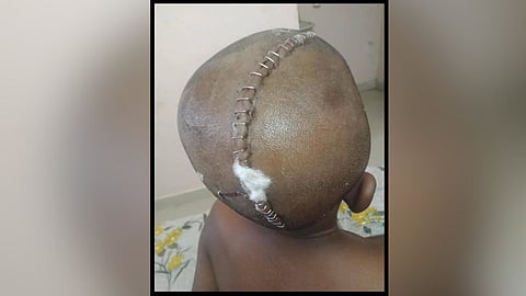 The head surgery of a Dalit child is horrifying.