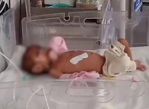 MP के सतना में कुपोषण का कहर जारी! 5 माह की बच्ची गंभीर हालत में, 2.3 किलो वजन के साथ रीवा रेफर