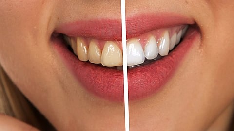 Is It Okay For Teeth To Be Yellow?