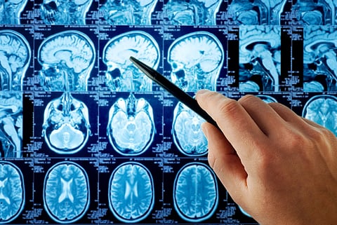 More Than 1.5 Lakh People In The UK Live With MS, A Condition Affecting The Brain And Spinal Cord