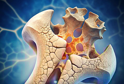 It’s Unacceptable: Global Call to Prioritise Bone Health as Osteoporosis Hits 500 Million Worldwide