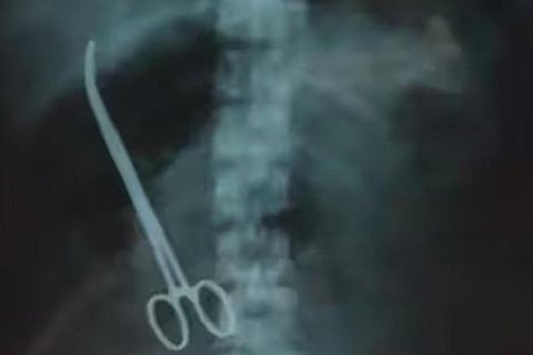Forceps left in woman's stomach during C-Section at Andhra hospital