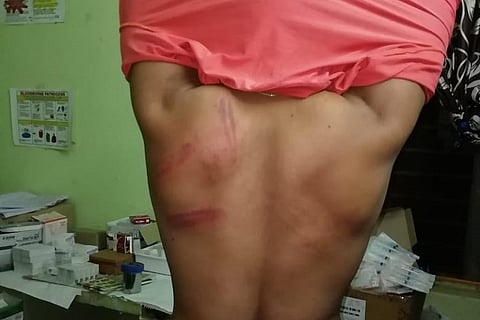 After attack on Forest Officer, 2 more dept personnel beaten in Telangana