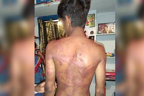 A Dalit man was brutally attacked for being in a relationship with a woman from Goud community