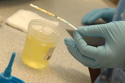 Health Check: What can your doctor tell from your urine?