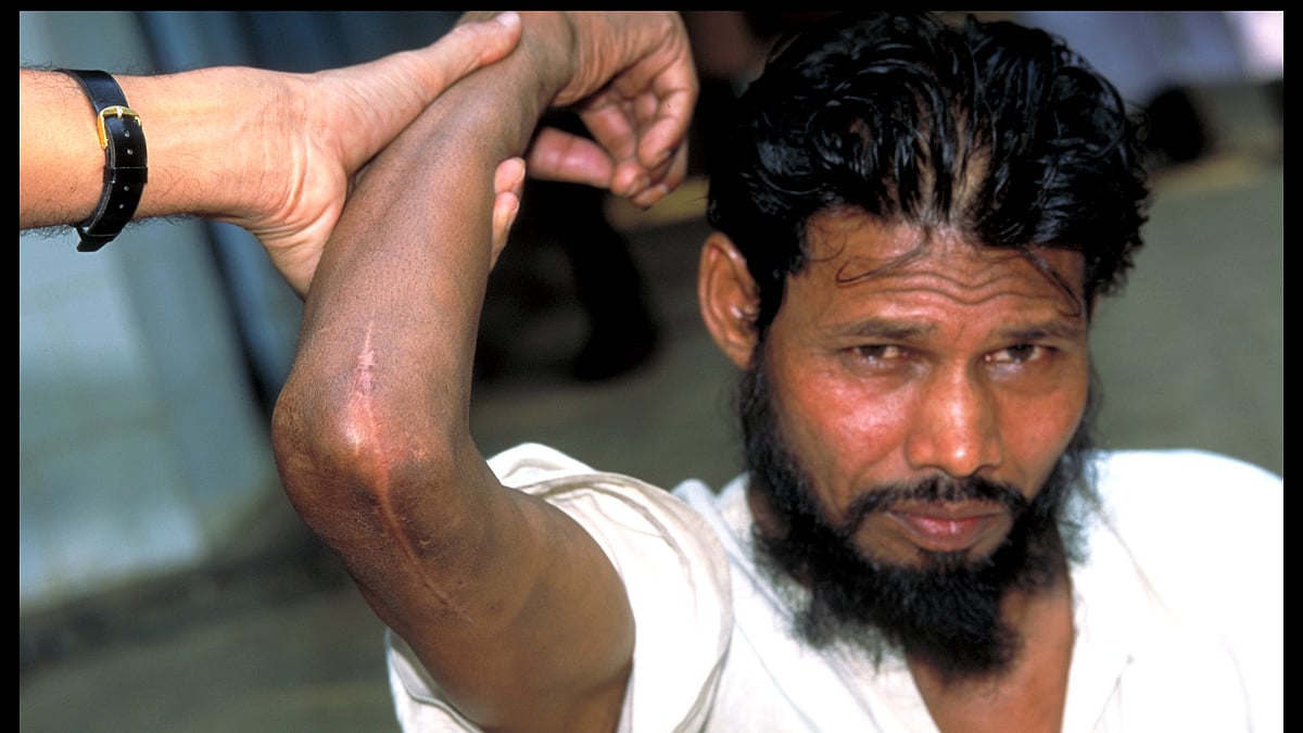 India is still home to 60% of the world’s leprosy cases (Photo courtesy: Sasakawa India Leprosy Foundation; W.H.O/ Acworth Municipal Hospital for Leprosy)