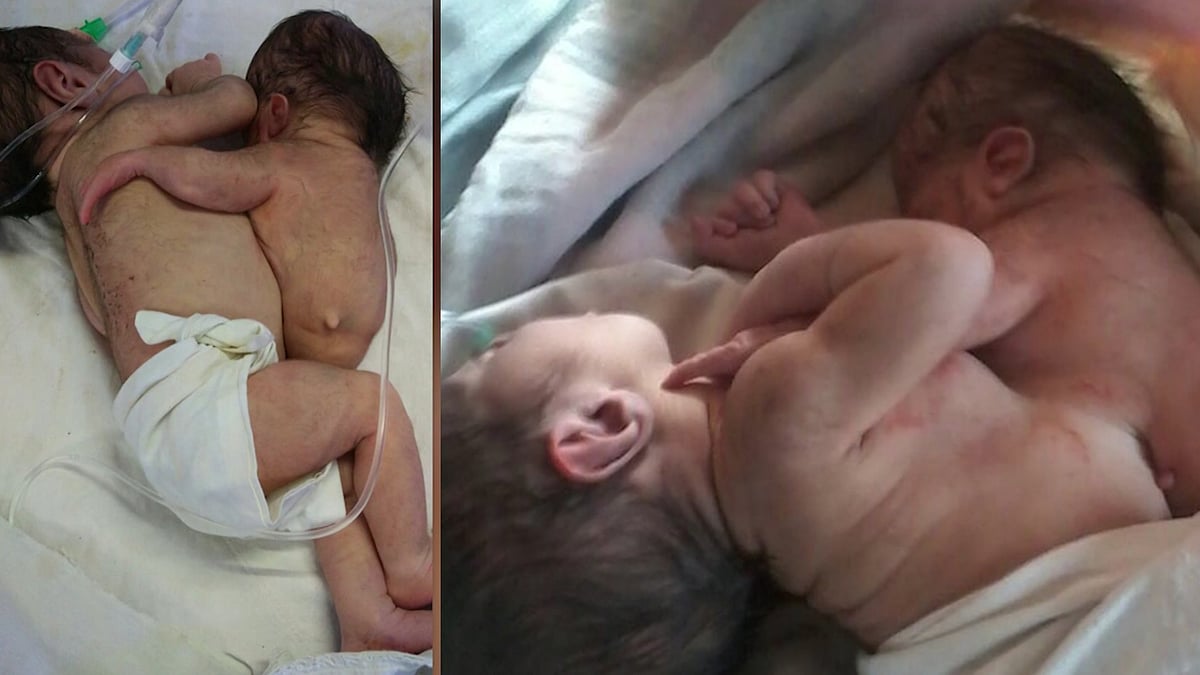 Parasitic twins (Photo: AP)
