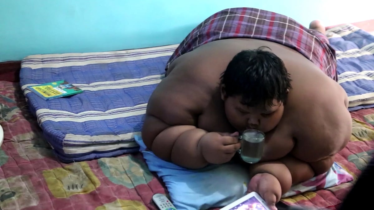 Arya Permana before surgery, at 192 kg. (Photo Courtesy: AP Screengrab)