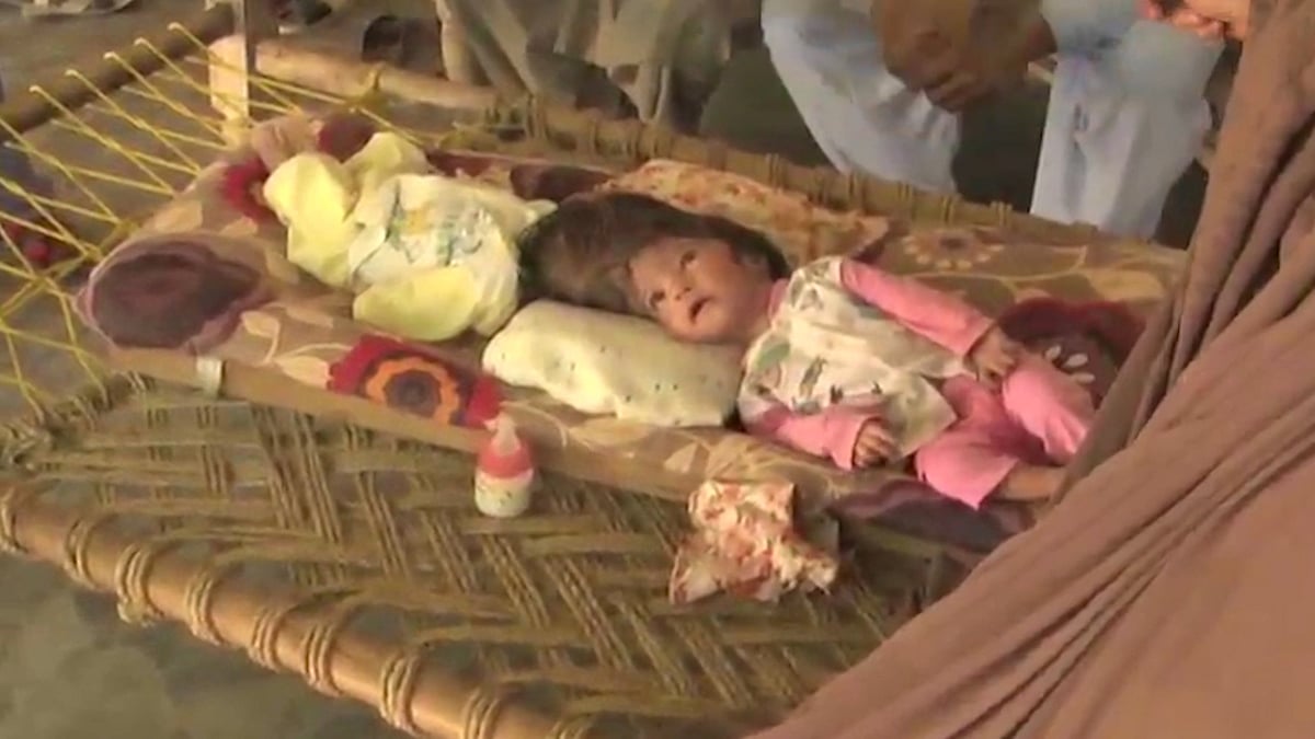 Conjoined twins in Pakistan (<b>Photo:</b> AP screengrab)