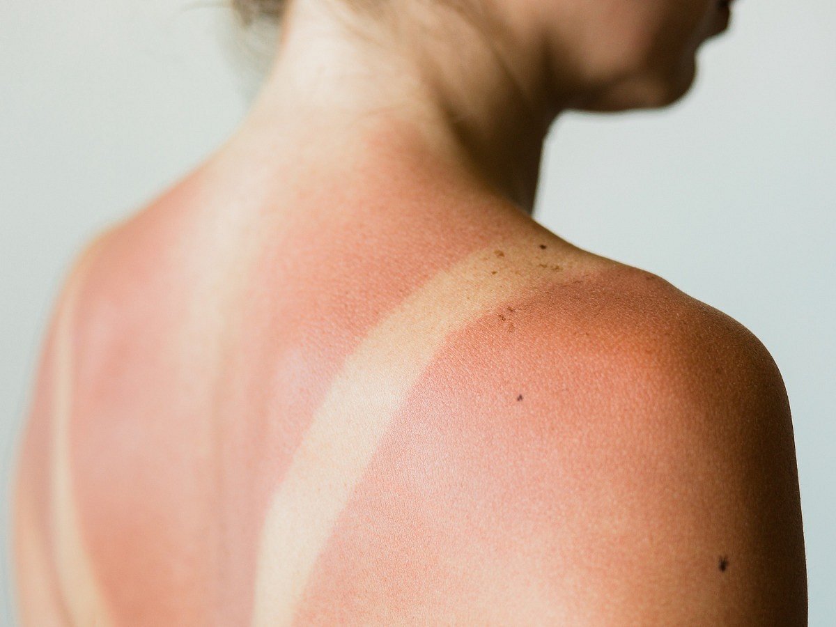 <div class="paragraphs"><p>Hacks to remove the stubborn tan. Image used for representative purposes.&nbsp;</p></div>