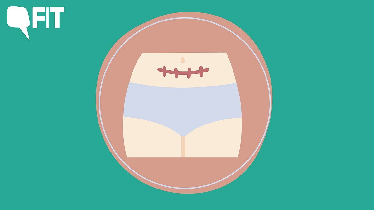 <div class="paragraphs"><p>Hysterectomy - a surgery that might not be quite encouraged societally but when the situation demands, we have to broaden our horizons.</p></div>
