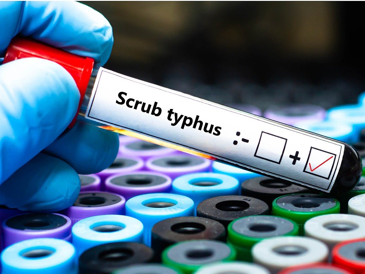 <div class="paragraphs"><p>Everything you need to know about scrub typhus</p></div>