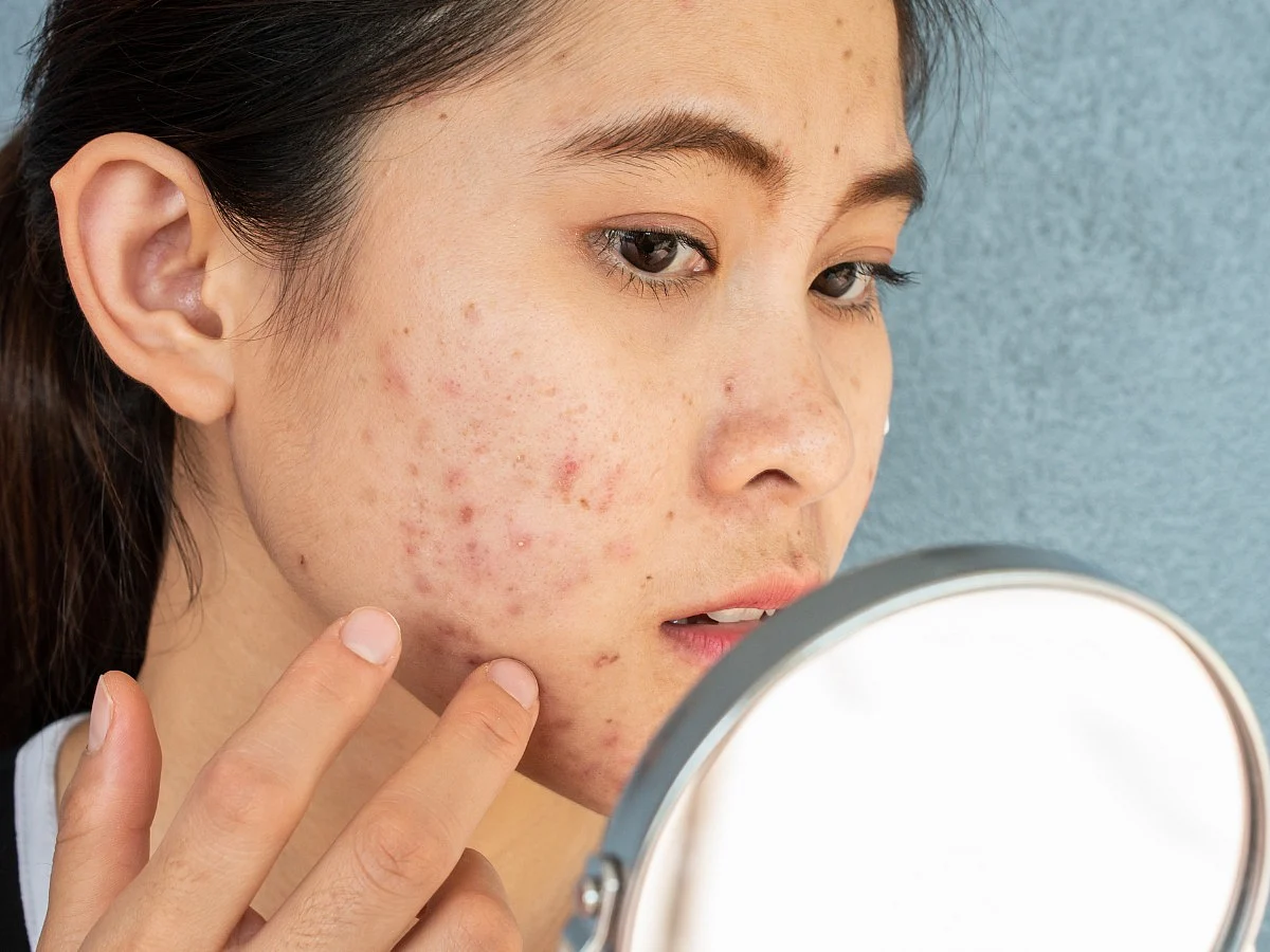<div class="paragraphs"><p>acne tips </p></div>