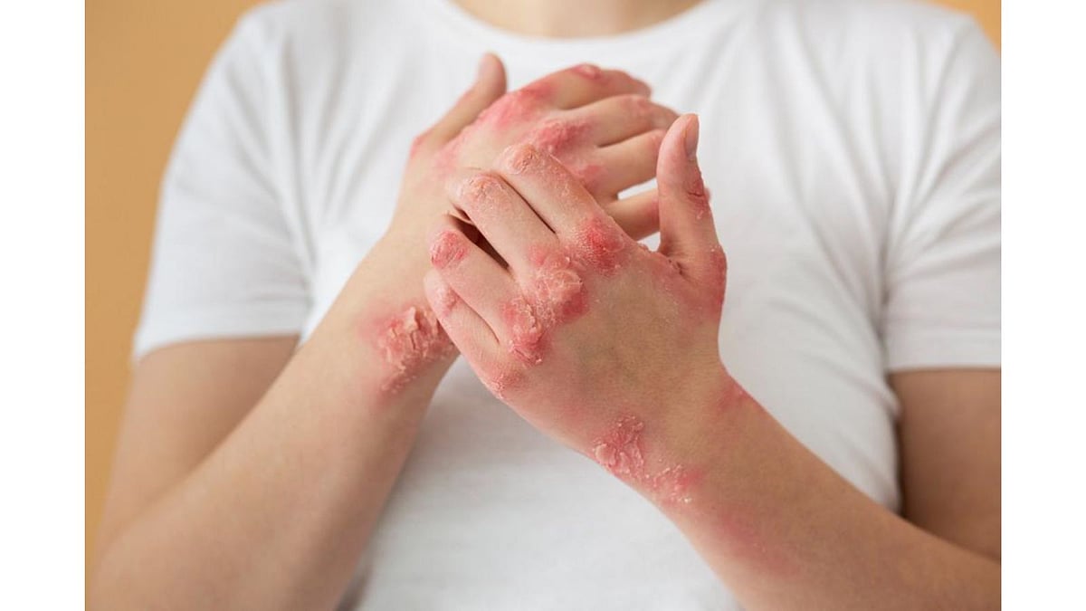 <div class="paragraphs"><p>Eczema Treatment That Works: Homeopathy &amp; Modern Care for Lasting Relief</p></div>