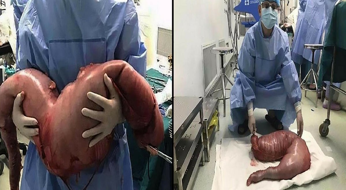22 Yrs Of Constipation: 13 Kg of ‘Poop’ Surgically Removed