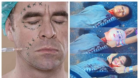 Facial Transplantation