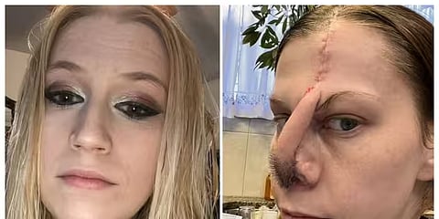cocaine usage lady lose noses