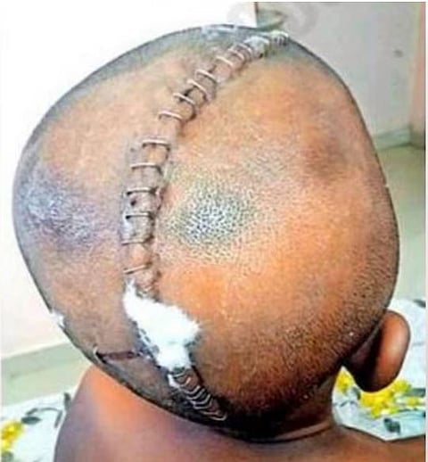 Head Injury