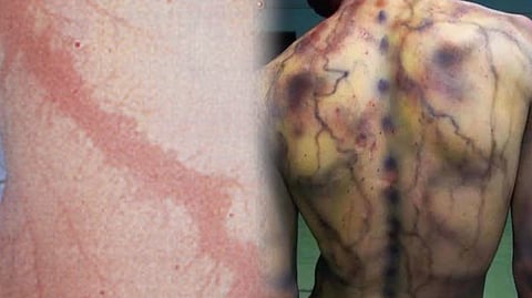 Know about Lichtenberg figures