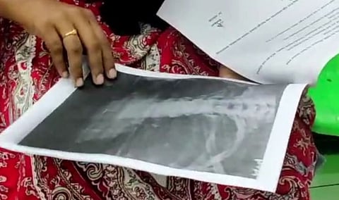 Malpractice : 'ഗൈഡ് വയർ പുറത്തെടുക്കുന്നത് റിസ്ക്, രക്‌ത കുഴൽ പൊട്ടാൻ സാധ്യത, ഇക്കാര്യം സുമയ്യയെ ബോധ്യപ്പെടുത്തും': മെഡിക്കൽ ബോർഡ് യോഗം