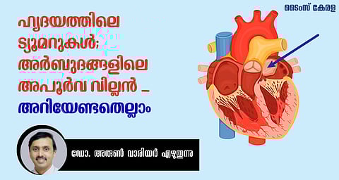 ഹൃദയത്തിലെ ട്യൂമറുകൾ; അർബുദങ്ങളിലെ അപൂർവ വില്ലൻ - അറിയേണ്ടതെല്ലാം