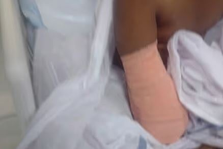 Hospital : 9കാരിയുടെ കൈ മുറിച്ചു മാറ്റിയ സംഭവം : പാലക്കാട് ജില്ലാ ആശുപത്രിയിലെ 2 ഡോക്ടർമാർക്ക് സസ്‌പെൻഷൻ