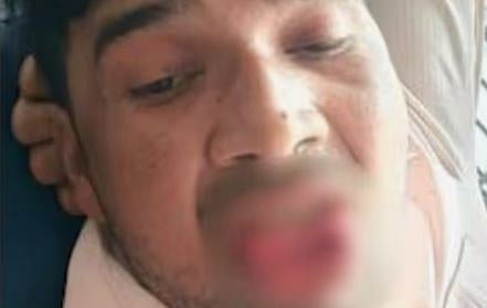 ബലം പ്രയോഗിച്ച് ചുംബിക്കാനും  പീഡിപ്പിക്കാനും ശ്രമം: മുൻ കാമുകൻ്റെ നാക്ക് കടിച്ച് മുറിച്ച് യുവതി | Rape