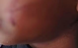 വർക്കലയിൽ 5 വയസ്സുകാരിയെ തെരുവു നായ ക്രൂരമായി ആക്രമിച്ചു: മുഖത്തും കൈ കാലുകളിലും ആഴത്തിൽ മുറിവ് | Stray dog