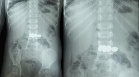 Child swallowed batteries Wayanad