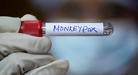 മങ്കിപോക്സ്‌ ലക്ഷണങ്ങൾ സംശയിക്കുന്ന യുവാവിന്റെ ആരോഗ്യനില ത്യപ്തികരം