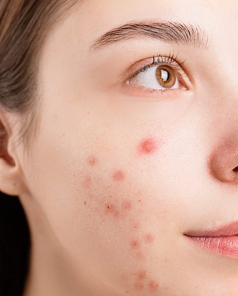 മുഖക്കുരു തടയാന്‍ എട്ടു വഴികള്‍..!! Eight ways to prevent acne.